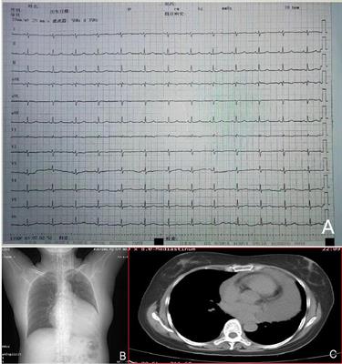 Unveiling the mystery: a rare case of localized malignant pericardial mesothelioma—case report